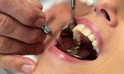En yaygın ağız sağlığı sorunu diş çürüğü