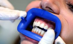 Diş beyazlatma kitleri için "zarar verebilir" uyarısı