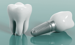 Diş implantı nedir ve nasıl uygulanır?