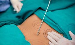 Liposuction nedir ve nasıl uygulanır?