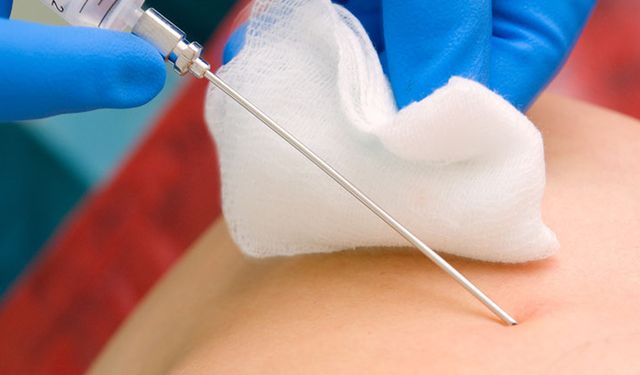 Biyopsi Nedir ve Hangi Durumlarda Yapılır?