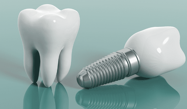 Diş implantı nedir ve nasıl uygulanır?