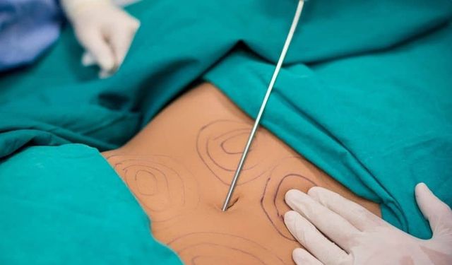 Liposuction nedir ve nasıl uygulanır?