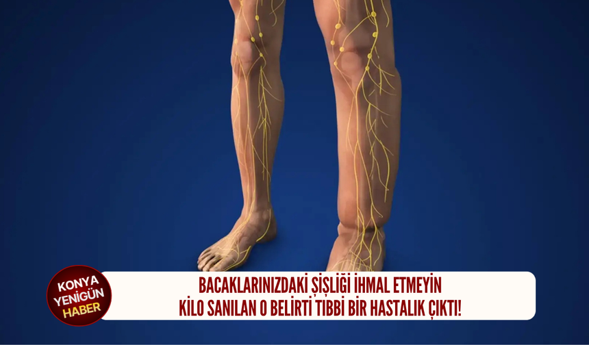 Bacaklarınızdaki şişliği ihmal etmeyin: Kilo sanılan o belirti tıbbi bir hastalık çıktı!